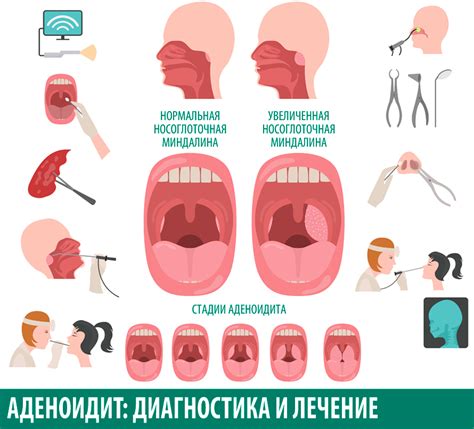 Аденоиды: основные причины и факторы развития у детей