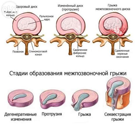 Альтернативные методы лечения грыжи позвоночника