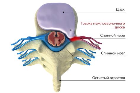 Альтернативные методы лечения грыжи шейного отдела