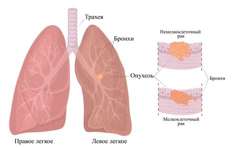 Виды болей при раке легких