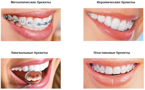 Виды брекет-систем для верхней челюсти и их особенности