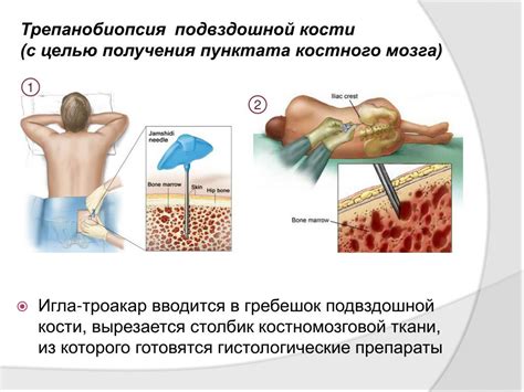 Виды заболеваний, при которых применяется пересадка костного мозга