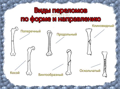 Виды переломов