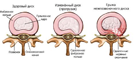 Влияет ли локализация грыжи позвоночника на повышение температуры