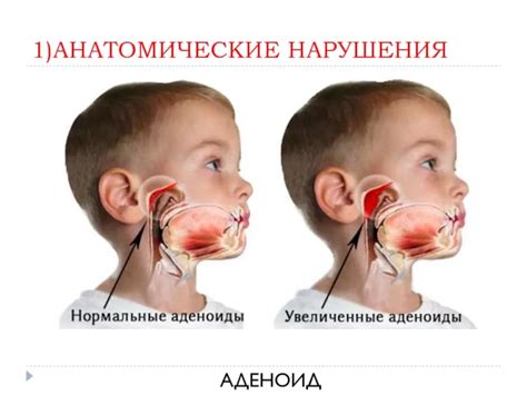 Влияние аденоидов на здоровье и развитие ребенка