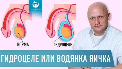 Влияние водянки яичек на здоровье мальчика в будущем