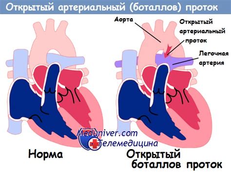 Влияние закрытия боталлов проток и овального окна на организм