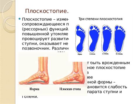 Влияние физкультуры на плоскостопие