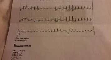 Влияние эмоционального состояния на результаты ЭКГ у ребенка