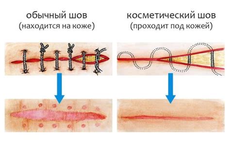 Возможные осложнения от отсутствия удаления швов