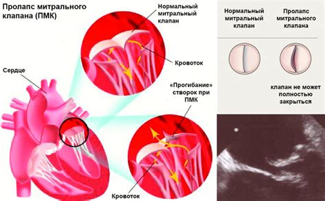 Возможные способы лечения пролапса митрального клапана