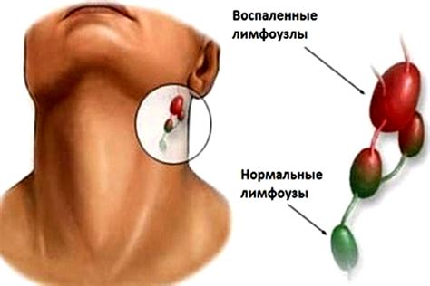 Воспаление лимфоузла: возможные причины