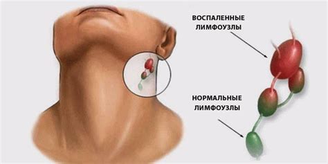 Воспаление лимфоузла: основные признаки