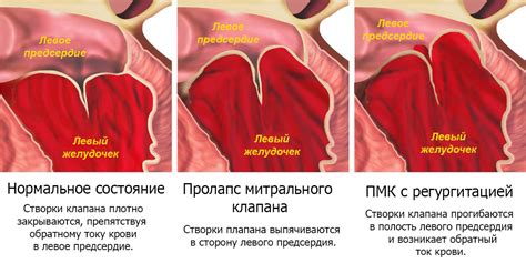 Воспалительные процессы и пролапс митрального клапана