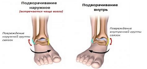 Восстановление после порвания связок на голеностопе