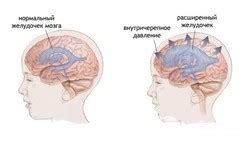 Вред и преимущества питья найз при повышенном давлении