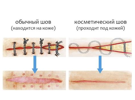 Где и как снимают швы после операции на губе