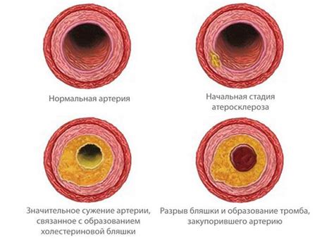 Диагностика атеросклеротических бляшек