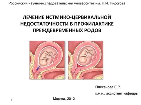 Диагностика и лечение преждевременных родов