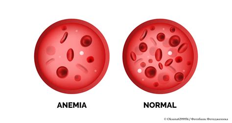 Диагностика недостатка гемоглобина