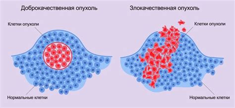 Доброкачественная опухоль в голове: что это и почему ее удаляют?