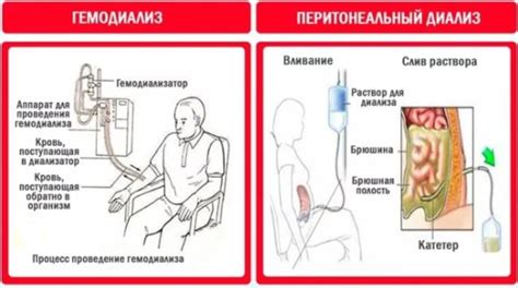 Достоинства и недостатки разового диализа