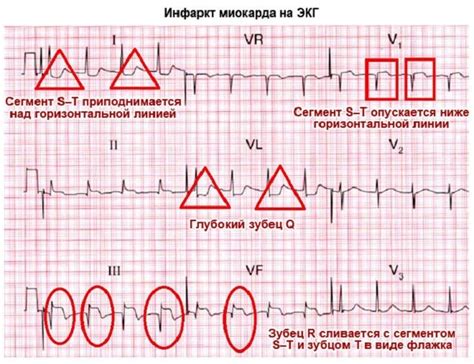 Запись ЭКГ: пример и дополнительные рекомендации