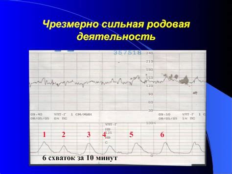 КТГ и схватки: надежная шкала времени для принятия решения о походе в родильный дом