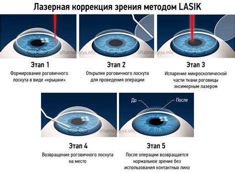 Какие этапы проходит заживление роговицы после лазерной коррекции зрения?