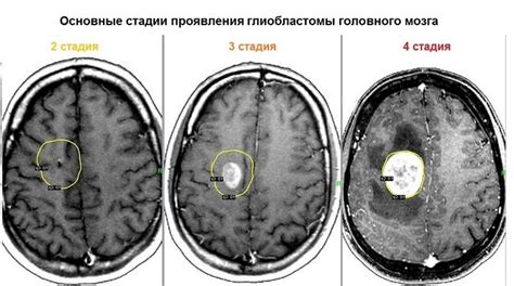 Как использовать результаты электроэнцефалограммы при диагностике и лечении опухоли головного мозга