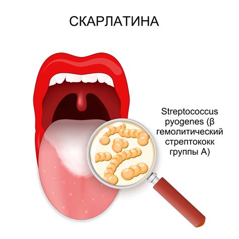 Как передается скарлатина от ребенка взрослому