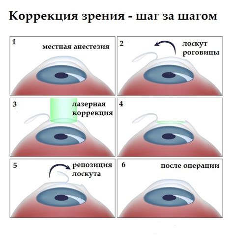 Как получить квоты на коррекцию зрения