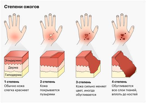 Как правильно проткнуть волдырь от ожога