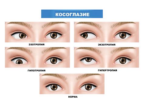 Как проводится диагностика косоглазия