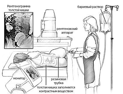 Как проводится ирригоскопия?