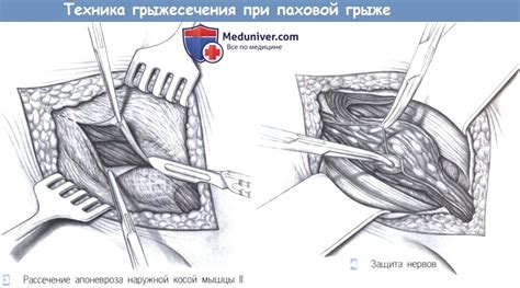 Как снизить температуру при паховой грыже