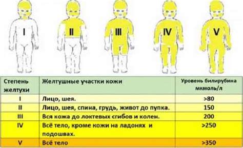 Когда и как проходит желтушка у новорожденных?