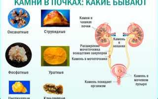 Когда можно начать прием Канефрона для почечных камней