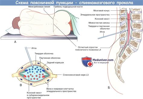 Когда производят пункцию спинного мозга