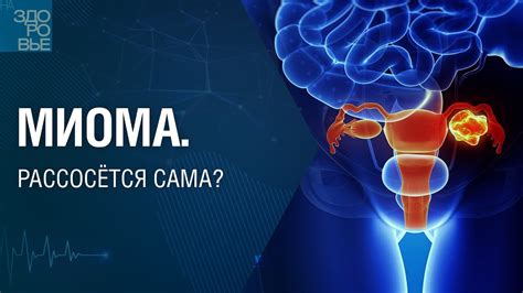 Может ли миома раствориться самостоятельно?