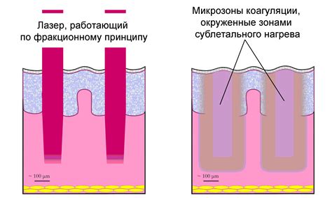 Можно ли удалить полип при выкидыше?