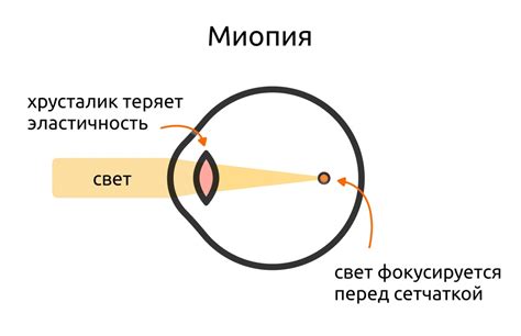 Нарушение рефракции глаза