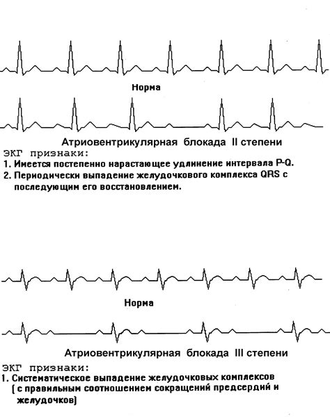 Нарушение электрических импульсов