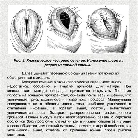 Необходимость второго кесарева сечения