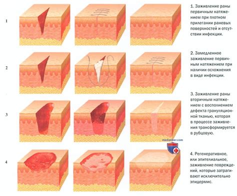 Неправильное заживление раны