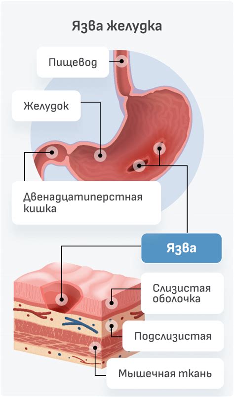 Ограничения при язве двенадцатиперстной