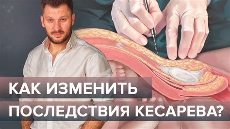 Опасно ли есть сыр после кесарева сечения?