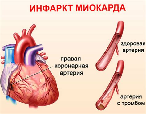 Основные рекомендации после гипертонического криза