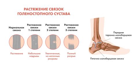 Основные симптомы растяжения связок на голеностопе