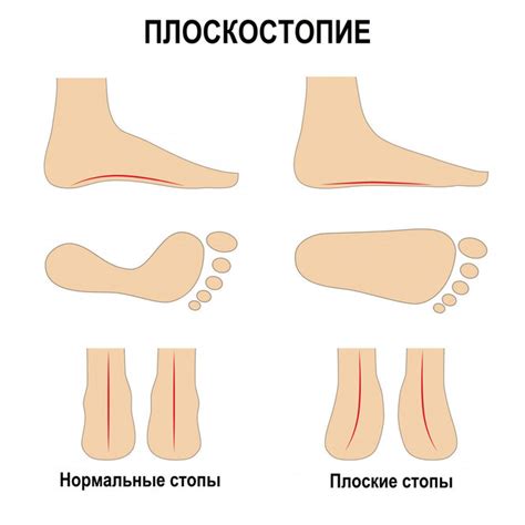 Особенности выбора физкультурных упражнений с плоскостопием